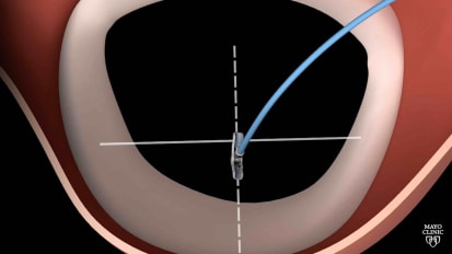 Minimally invasive treatment for mitral valve disease