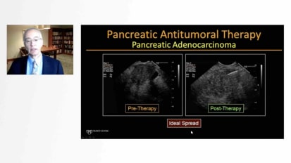 Endoscopic ultrasound (EUS)-guided pancreatic anti-tumoral therapy