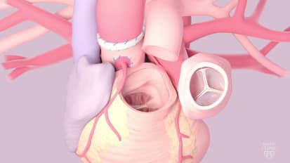 Mayo Clinic Ross procedure for the treatment of aortic valve disease