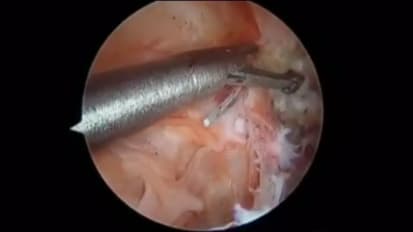 Arthroscopic technique for distal tibial allograft bone augmentation with suture anchor fixation for anterior shoulder instability