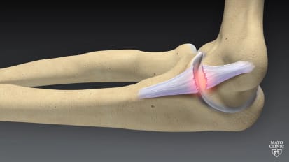 Mayo Clinic orthopedics and sports medicine: Tommy John & elbow injuries