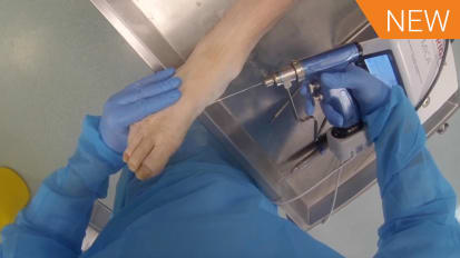 MICA Chevron - GoPro Surgical Video [016442]