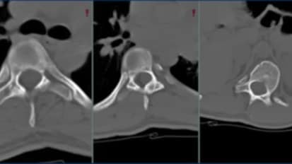 Minimally Invasive Spine Surgery: State of the Art and Future Directions