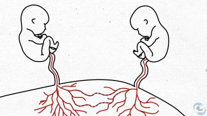 Twin to Twin Transfusion Syndrome: Part 1 of 2