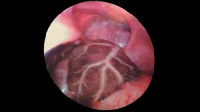 A Morgagni Hernia with an Absent Ductus Venosus