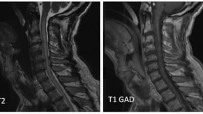 Multiple Sclerosis and Other Inflammatory Disorders of the Central Nervous System