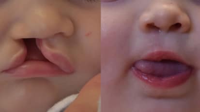 Cleft Lip Repair - Fisher Subunit Approach