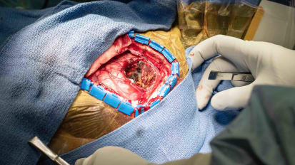 Awake Craniotomy and Tumor Resection