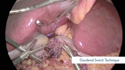 Duodenal Switch Procedure Technique and Variations
