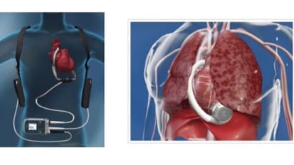 Heartmate II/III and HeartWare HVAD Overview