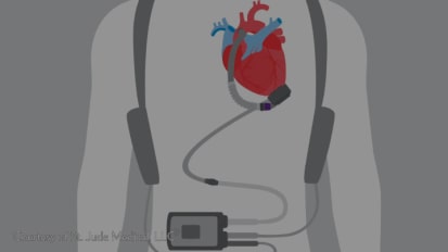 Evolving Therapies for Advanced Heart Failure