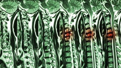 Degenerative Cervical Myelopathy: Updates, Challenges, and Future Directions