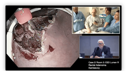Rectal ESD with Lumen R