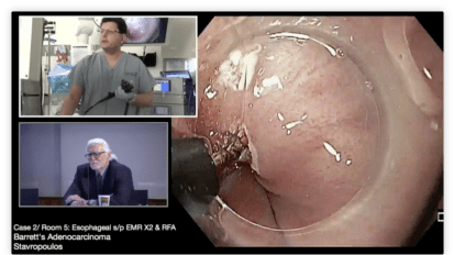 Esophageal Endoscopic Submucosal Dissection