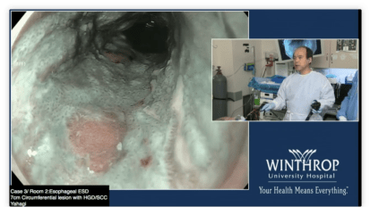 7cm Circumferential Lesion with HGB SCC Immediately Distal to UES