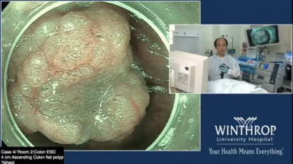 4cm Granular Ascending Colon ESD 