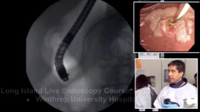 Ampullary Adenoma Ampullectomy