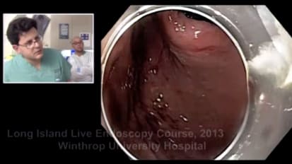 Endoscopic Full Thickness Resection