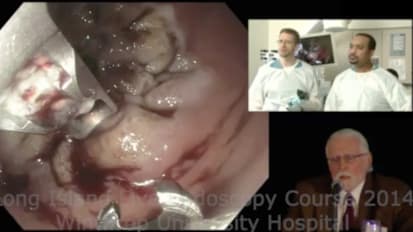 Incisionless Revision of Post Rouxen Y Bypass Stomal and Pouch Dilation