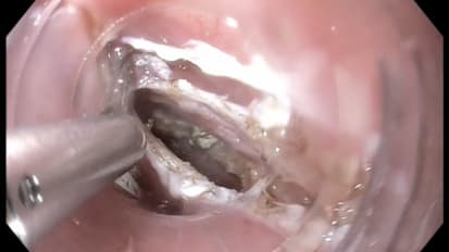 Z-POEM (Diverticulotomy for Zenker’s diverticulum)