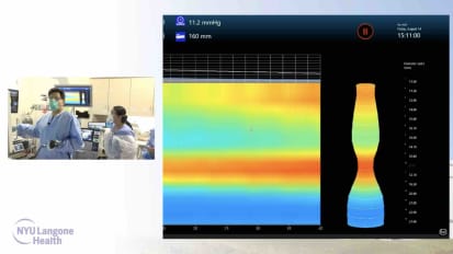 POEM (Endoflip/Anti-Reflux POEM in type 3 achalasia)