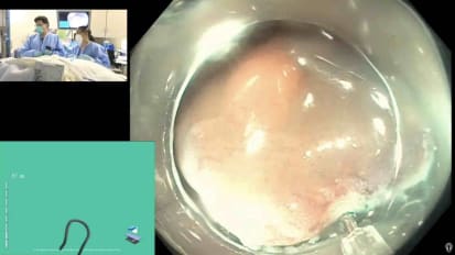 克隆ESDDiLumen/Nevel牵引设备/Suring)