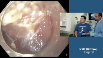 Tunnel-assisted Endoscopic Submucosal Dissection (ESD) of Gastric High Grade Dysplasia (HGD)