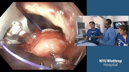 Gastric Per Oral Endoscopic Myotomy (G-POEM) for Gastroparesis Due to Post-Operative Vagus Nerve Injury