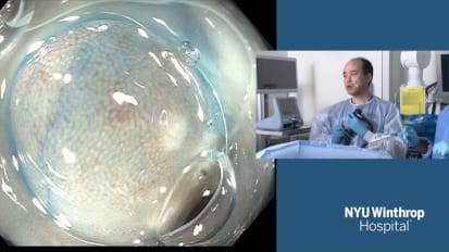 Colon Endoscopic Submucosal Dissection (ESD)