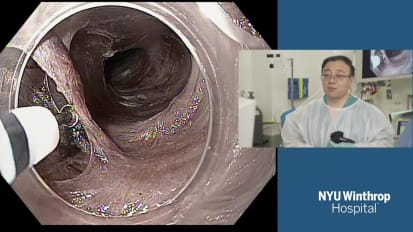 Per Oral Endoscopic Myotomy (POEM) After Failed Heller for Achalasia