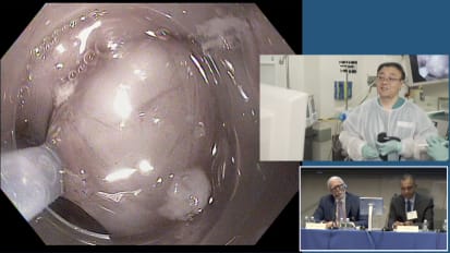 单生洞穴剖析GIST