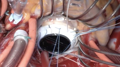 On-X Mitral Valve MV Replacement