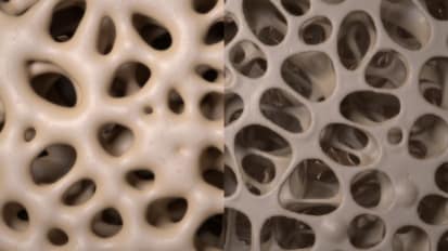 Osteoporosis Risk Factors and Treatments