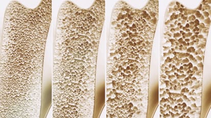 Osteoporosis and the UCSF Metabolic Bone Clinic