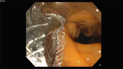 Endoscopic Ultrasound (EUS)-guided Choledochoduodenostomy
