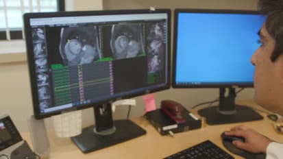 Cardiac MRI effective in identifying myocarditis in athletes following COVID-19