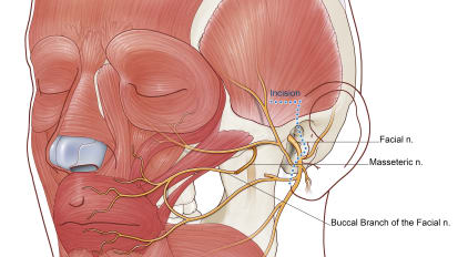 Reanimating the Paralyzed Face