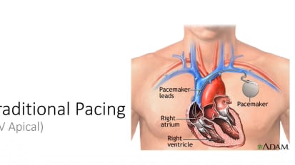 Left Bundle Area Pacing