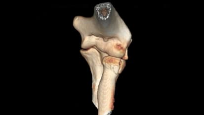 EVOLVE™ Modular Radial Head Surgical Technique with Graham King, MD MSc FRCSC (Part 01/10) [013567]