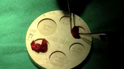 EVOLVE™ Modular Radial Head Surgical Technique with Graham King, MD MSc FRCSC (Part 04/10) [SO637-711]