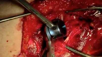 EVOLVE™ Modular Radial Head Surgical Technique with Graham King, MD MSc FRCSC (Part 05/10) [SO637-711]