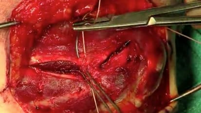 EVOLVE™ Modular Radial Head Surgical Technique with Graham King, MD MSc FRCSC (Part 07/10) [SO637-711]