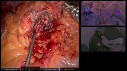 Partial Nephrectomy