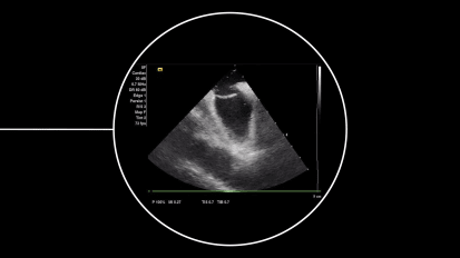 Do PFO characteristics determine recurrent stroke risk?