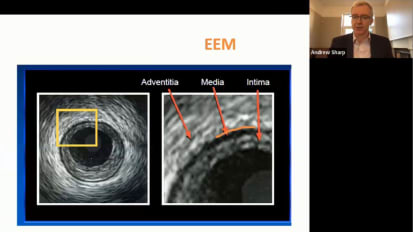 Key measurement and vessel sizing techniques for utilizing IVUS in routine and complex cases; outlined in easy to understand steps