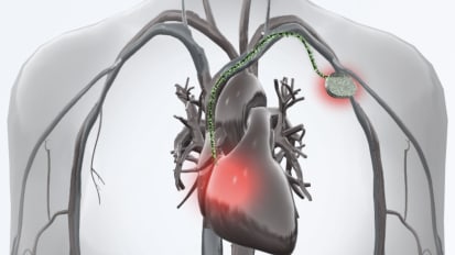 Cardiac device Infection