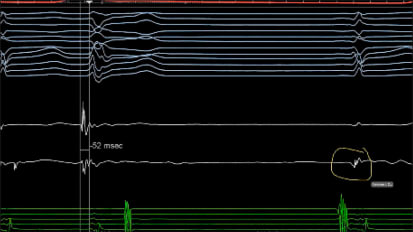 Complex PVC ablation: Tips and tricks for success — Cardiovascular Medicine webinar