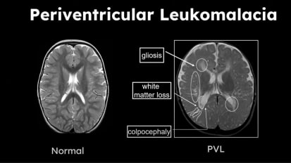 More than a White Matter Injury: Vulnerability of the Preterm Brain and Periventricular Leukomalacia (PVL)