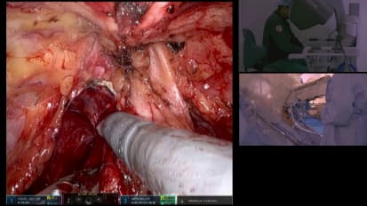 Radical Prostatectomy
