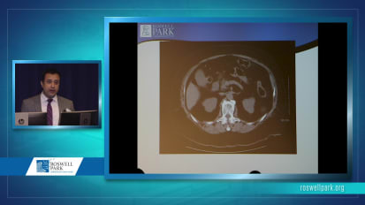 Surgical Management of Pancreas Cancer